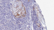 RGS21 Antibody - 1:100 staining human Head and neck carcinoma tissue by IHC-P. The sample was formaldehyde fixed and a heat mediated antigen retrieval step in citrate buffer was performed. The sample was then blocked and incubated with the antibody for 1.5 hours at 22°C. An HRP conjugated goat anti-rabbit antibody was used as the secondary.