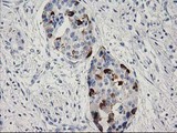 RGS5 Antibody - IHC of paraffin-embedded Carcinoma of Human pancreas tissue using anti-RGS5 mouse monoclonal antibody. (Heat-induced epitope retrieval by 10mM citric buffer, pH6.0, 100C for 10min).