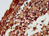 RGS6 Antibody - Immunohistochemistry image at a dilution of 1:300 and staining in paraffin-embedded human melanoma cancer performed on a Leica BondTM system. After dewaxing and hydration, antigen retrieval was mediated by high pressure in a citrate buffer (pH 6.0) . Section was blocked with 10% normal goat serum 30min at RT. Then primary antibody (1% BSA) was incubated at 4 °C overnight. The primary is detected by a biotinylated secondary antibody and visualized using an HRP conjugated SP system.