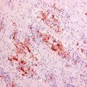 Rhizopus arrhizus WSSA Antibody - Renal tissue presenting zygomycosis stained with Mouse anti-Rhizopus Arrhizus