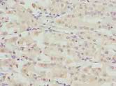 RIBC2 Antibody - Immunohistochemistry of paraffin-embedded human gastric cancer using antibody at dilution of 1:100.