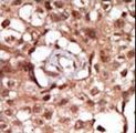 RICK / RIP2 Antibody - Formalin-fixed and paraffin-embedded human cancer tissue reacted with the primary antibody, which was peroxidase-conjugated to the secondary antibody, followed by AEC staining. This data demonstrates the use of this antibody for immunohistochemistry; clinical relevance has not been evaluated. BC = breast carcinoma; HC = hepatocarcinoma.