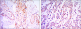 RICTOR Antibody - IHC of paraffin-embedded thyroid gland tissues (left) and human breast carcinoma (right) using RICTOR mouse monoclonal antibody with DAB staining.