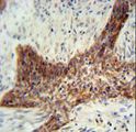 RILPL2 Antibody - RILPL2 antibody immunohistochemistry of formalin-fixed and paraffin-embedded human lung carcinoma followed by peroxidase-conjugated secondary antibody and DAB staining.
