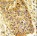 RIOK1 Antibody - Formalin-fixed and paraffin-embedded human lung carcinoma reacted with RIOK1 Antibody , which was peroxidase-conjugated to the secondary antibody, followed by DAB staining. This data demonstrates the use of this antibody for immunohistochemistry; clinical relevance has not been evaluated.