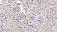 RLBP1 / CRALBP Antibody - 1:100 staining human thyroid carcinoma tissue by IHC-P. The sample was formaldehyde fixed and a heat mediated antigen retrieval step in citrate buffer was performed. The sample was then blocked and incubated with the antibody for 1.5 hours at 22°C. An HRP conjugated goat anti-rabbit antibody was used as the secondary.