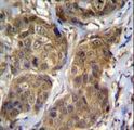 RNF11 Antibody - RNF11 Antibody immunohistochemistry of formalin-fixed and paraffin-embedded human breast carcinoma followed by peroxidase-conjugated secondary antibody and DAB staining.