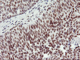RNF113B Antibody - IHC of paraffin-embedded Carcinoma of Human bladder tissue using anti-RNF113B mouse monoclonal antibody.