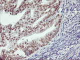 RNF113B Antibody - IHC of paraffin-embedded Adenocarcinoma of Human endometrium tissue using anti-RNF113B mouse monoclonal antibody.