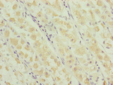 RNF135 Antibody - Immunohistochemistry of paraffin-embedded human gastric cancer at dilution of 1:100