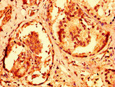 RNF168 Antibody - Immunohistochemistry image at a dilution of 1:600 and staining in paraffin-embedded human prostate cancer performed on a Leica BondTM system. After dewaxing and hydration, antigen retrieval was mediated by high pressure in a citrate buffer (pH 6.0) . Section was blocked with 10% normal goat serum 30min at RT. Then primary antibody (1% BSA) was incubated at 4 °C overnight. The primary is detected by a biotinylated secondary antibody and visualized using an HRP conjugated SP system.