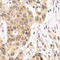 RNF2 / RING2 / RING1B Antibody - Immunohistochemistry of paraffin-embedded human esophageal cancer tissue.
