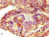 RNF219 Antibody - Immunohistochemistry image at a dilution of 1:300 and staining in paraffin-embedded human ovarian cancer performed on a Leica BondTM system. After dewaxing and hydration, antigen retrieval was mediated by high pressure in a citrate buffer (pH 6.0) . Section was blocked with 10% normal goat serum 30min at RT. Then primary antibody (1% BSA) was incubated at 4 °C overnight. The primary is detected by a biotinylated secondary antibody and visualized using an HRP conjugated SP system.