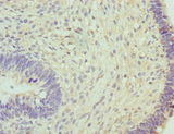 RNGTT / HCAP Antibody - Immunohistochemistry of paraffin-embedded human ovarian cancer at dilution 1:100
