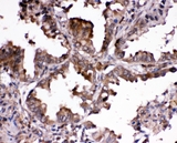 RNH1 Antibody - IHC analysis of RNH1 using anti-RNH1 antibody. RNH1 was detected in paraffin-embedded section of human lung cancer tissues. Heat mediated antigen retrieval was performed in citrate buffer (pH6, epitope retrieval solution) for 20 mins. The tissue section was blocked with 10% goat serum. The tissue section was then incubated with 1µg/ml rabbit anti-RNH1 Antibody overnight at 4°C. Biotinylated goat anti-rabbit IgG was used as secondary antibody and incubated for 30 minutes at 37°C. The tissue section was developed using Strepavidin-Biotin-Complex (SABC) with DAB as the chromogen.