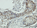 RNMT / HCM Antibody - Immunoperoxidase of monoclonal antibody to RNMT on formalin-fixed paraffin-embedded human squamous cell carcinoma tissue. [antibody concentration 3 ug/ml].