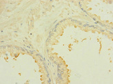 ROBO2 Antibody - Immunohistochemistry of paraffin-embedded human prostate cancer at dilution 1:100