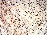 ROP1 Antibody - Immunohistochemical analysis of paraffin-embedded esophageal cancer tissues using ROP1 mouse mAb with DAB staining.