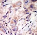 ROR2 Antibody - Formalin-fixed and paraffin-embedded human cancer tissue reacted with the primary antibody, which was peroxidase-conjugated to the secondary antibody, followed by DAB staining. This data demonstrates the use of this antibody for immunohistochemistry; clinical relevance has not been evaluated. BC = breast carcinoma.