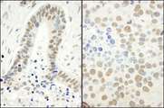 RPA2 / RFA2 / RPA34 Antibody - Detection of Human and Mouse RPA32 (S4/S8) by Immunohistochemistry. Sample: FFPE sections of human ovarian carcinoma (left) and mouse renal cell carcinoma (right). Antibody: Affinity purified rabbit anti-RPA32 (S4/S8) used at a dilution of 1:1000 (1 Detection: DAB.