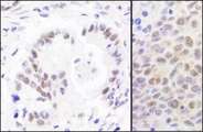 RPA70 / RPA1 Antibody - Detection of Human and Mouse RPA70 by Immunohistochemistry. Sample: FFPE sections of human stomach carcinoma (left) and mouse CT26 colon carcinoma (right). Antibody: Affinity purified rabbit anti-RPA70 used at a dilution of 1:1000 (1 ug/ml). Detection: DAB.