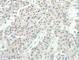 RPAP3 / FLJ21908 Antibody - Immunohistochemistry of paraffin-embedded Human lung cancer using RPAP3 Polyclonal Antibody at dilution of 1:20.