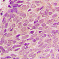 RPL12 / Ribosomal Protein L12 Antibody - Immunohistochemical analysis of RPL12 staining in human breast cancer formalin fixed paraffin embedded tissue section. The section was pre-treated using heat mediated antigen retrieval with sodium citrate buffer (pH 6.0). The section was then incubated with the antibody at room temperature and detected using an HRP conjugated compact polymer system. DAB was used as the chromogen. The section was then counterstained with hematoxylin and mounted with DPX.