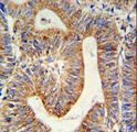 RPL17 / Ribosomal Protein L17 Antibody - RPL17 Antibody IHC of formalin-fixed and paraffin-embedded colon carcinoma followed by peroxidase-conjugated secondary antibody and DAB staining.