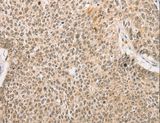 RPL26L1 Antibody - Immunohistochemistry of paraffin-embedded Human lung cancer using RPL26L1 Polyclonal Antibody at dilution of 1:30.