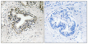RPL30 / Ribosomal Protein L30 Antibody - Immunohistochemistry analysis of paraffin-embedded human prostate carcinoma tissue, using RPL30 Antibody. The picture on the right is blocked with the synthesized peptide.