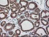 RPN1 / Ribophorin I Antibody - IHC of paraffin-embedded Carcinoma of Human thyroid tissue using anti-RPN1 mouse monoclonal antibody.