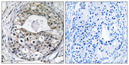 RPS13 / Ribosomal Protein S13 Antibody - Immunohistochemistry analysis of paraffin-embedded human breast carcinoma tissue, using RPS13 Antibody. The picture on the right is blocked with the synthesized peptide.