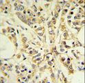 RPS13 / Ribosomal Protein S13 Antibody - RPS13 Antibody IHC of formalin-fixed and paraffin-embedded breast carcinoma followed by peroxidase-conjugated secondary antibody and DAB staining.