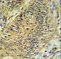 RPS15A Antibody - RPS15A Antibody IHC of formalin-fixed and paraffin-embedded colon carcinoma followed by peroxidase-conjugated secondary antibody and DAB staining.