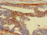RPS5 / Ribosomal Protein S5 Antibody - Immunohistochemistry of paraffin-embedded human colon cancer at dilution of 1:100