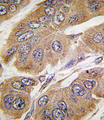 RPS6KB1 / P70S6K / S6K Antibody - Formalin-fixed and paraffin-embedded human breast carcinoma tissue reacted with RPS6KB1 Antibody (T421) , which was peroxidase-conjugated to the secondary antibody, followed by DAB staining. This data demonstrates the use of this antibody for immunohistochemistry; clinical relevance has not been evaluated.