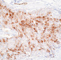 RPSA / Laminin Receptor Antibody - Formalin-fixed, paraffin-embedded human breast carcinoma stained with peroxidase-conjugate and DAB chromogen. Note cell membrane with some cytoplasmic staining of tumor cells.  This image was taken for the unmodified form of this product. Other forms have not been tested.