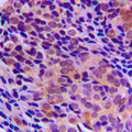 RRAGA+B Antibody - Immunohistochemical analysis of RagA/B staining in human prostate cancer formalin fixed paraffin embedded tissue section. The section was pre-treated using heat mediated antigen retrieval with sodium citrate buffer (pH 6.0). The section was then incubated with the antibody at room temperature and detected using an HRP conjugated compact polymer system. DAB was used as the chromogen. The section was then counterstained with hematoxylin and mounted with DPX.