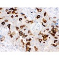 RRM2 Antibody - RRM2 antibody IHC-paraffin. IHC(P): Human Mammary Cancer Tissue.