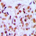 RRP8 Antibody - Immunohistochemical analysis of RRP8 staining in human breast cancer formalin fixed paraffin embedded tissue section. The section was pre-treated using heat mediated antigen retrieval with sodium citrate buffer (pH 6.0). The section was then incubated with the antibody at room temperature and detected with HRP and DAB as chromogen. The section was then counterstained with hematoxylin and mounted with DPX.