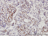 RRP9 Antibody - Immunoperoxidase of monoclonal antibody to RNU3IP2 on formalin-fixed paraffin-embedded human ovary, clear cell carcinoma. [antibody concentration 3 ug/ml].