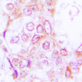 Antibody - Immunohistochemical analysis of RSK1/2/3 (pT573/570/577) staining in human lung cancer formalin fixed paraffin embedded tissue section. The section was pre-treated using heat mediated antigen retrieval with sodium citrate buffer (pH 6.0). The section was then incubated with the antibody at room temperature and detected using an HRP conjugated compact polymer system. DAB was used as the chromogen. The section was then counterstained with hematoxylin and mounted with DPX.