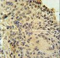 RSPO2 Antibody - RSPO2 Antibody immunohistochemistry of formalin-fixed and paraffin-embedded human lung carcinoma followed by peroxidase-conjugated secondary antibody and DAB staining.