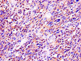 RTCB / C22orf28 Antibody - Immunohistochemistry of paraffin-embedded human glioma cancer using RTCB Antibody at dilution of 1:100