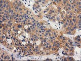 RTN4IP1 / NIMP Antibody - IHC of paraffin-embedded Carcinoma of Human bladder tissue using anti-RTN4IP1 mouse monoclonal antibody.