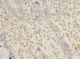 RTP4 / IFRG28 Antibody - Immunohistochemistry of paraffin-embedded human colon cancer using antibody at dilution of 1:100.