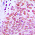 RXRG Antibody - Immunohistochemical analysis of RXR gamma staining in human breast cancer formalin fixed paraffin embedded tissue section. The section was pre-treated using heat mediated antigen retrieval with sodium citrate buffer (pH 6.0). The section was then incubated with the antibody at room temperature and detected using an HRP conjugated compact polymer system. DAB was used as the chromogen. The section was then counterstained with hematoxylin and mounted with DPX.