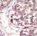 RYK Antibody - Formalin-fixed and paraffin-embedded human cancer tissue reacted with the primary antibody, which was peroxidase-conjugated to the secondary antibody, followed by DAB staining. This data demonstrates the use of this antibody for immunohistochemistry; clinical relevance has not been evaluated. BC = breast carcinoma; HC = hepatocarcinoma.
