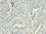 S100PBP Antibody - Immunohistochemistry of paraffin-embedded human lung cancer using antibody at dilution of 1:100.