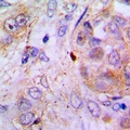 S100Z Antibody - Immunohistochemical analysis of S100-Z staining in human lung cancer formalin fixed paraffin embedded tissue section. The section was pre-treated using heat mediated antigen retrieval with sodium citrate buffer (pH 6.0). The section was then incubated with the antibody at room temperature and detected using an HRP conjugated compact polymer system. DAB was used as the chromogen. The section was then counterstained with haematoxylin and mounted with DPX.